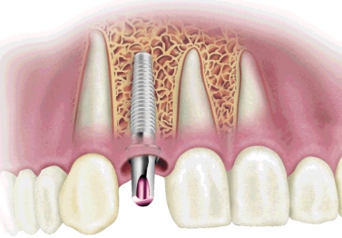 Имплантация зубов