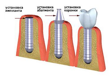 Имплант