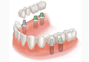 Протезирование зубов Харьков, несъемное протезирование